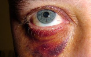 Man with a black eye