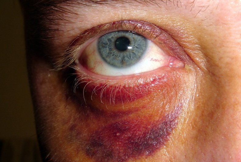 Intimate Partner Violence and Abuse Photo Dion Gillard Man with a black eye